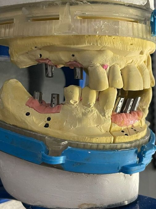 Un modello in gesso con impianti dentali